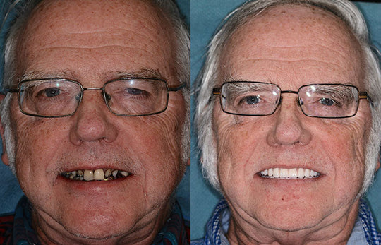 Moktan Sabai LumaDent Custom Full Dentures – Natural Fit Ivory & White Teeth Set