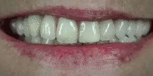 Moktan Sabai LumaGrin Snap-On Veneers Upper & Lower Teeth, Removable Smile Cover