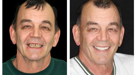 Moktan Sabai LumaDent Custom Full Dentures – Natural Fit Ivory & White Teeth Set