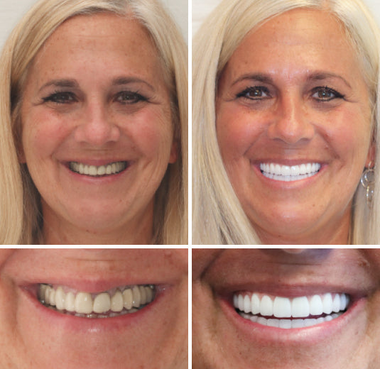 Moktan Sabai LumaDent Custom Full Dentures – Natural Fit Ivory & White Teeth Set