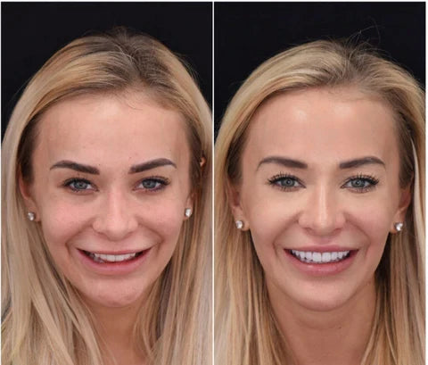 Moktan Sabai LumaGrin Snap-On Veneers Upper & Lower Teeth, Removable Smile Cover
